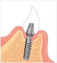 インプラント施術イメージ