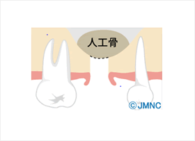 骨造成による治療